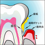 歯槽膿漏 ㈱サンギ提供