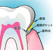 歯肉炎㈱サンギ提供